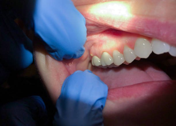 Best Emergency Treatment for Dental Infections or Abscesses in Aromas, CA