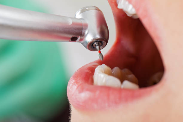 Best Emergency Tooth Extraction in Aromas, CA
